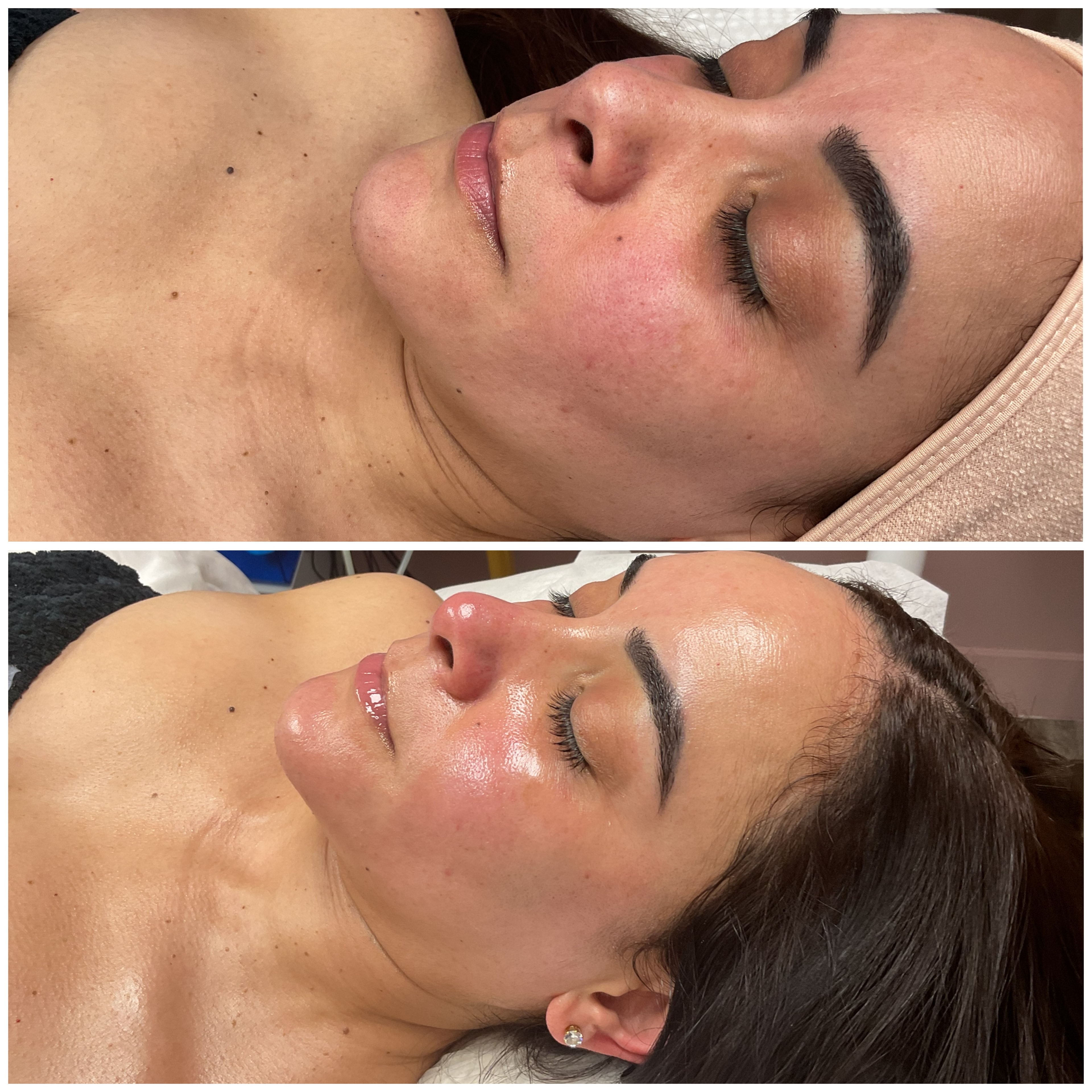 Facial Rejuvenation Result