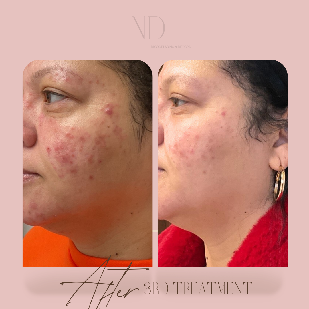 Facial Rejuvenation Before & After