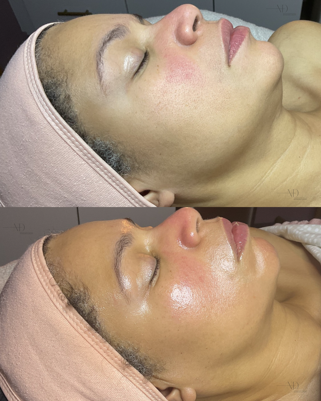 She Didn't Get Filler — Before & After